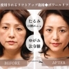 ボワールリフティングでリフトアップ実感！若々しいお肌へ　