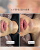 5回の施術でヒゲがスッキリ！「ヒゲ脱毛5回のビフォーアフター【口元の変化をご紹介】」