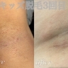 キッズ脱毛3回目の変化✨　　　海南市エステサロン