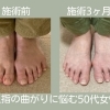 足のゆがみと歩き方の変化｜50代女性の改善事例