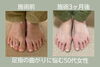 「足のゆがみと歩き方の変化｜50代女性の改善事例」