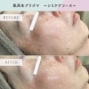 肌再生プラズマ《シミケアコース》Before→Afterのご紹介