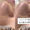 鏡を見るのが楽しみに？ソニックエステで鼻の黒ずみ毛穴ケア