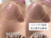 長年の黒ずみもスッキリ解消「鏡を見るのが楽しみに？ソニックエステで鼻の黒ずみ毛穴ケア」