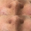毛穴ケアで驚くほど滑らか肌へ「お顔の毛穴全て毎回キレイに【福井毛穴サロン/福井フェイシャルサロン/福井フェイシャルエステ】」