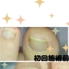 巻き爪でお悩みではないですか？？爪切りから矯正器具まで👣行います💪大阪駅・梅田駅から2駅にある足のトラブルに特化したフットケアサロン👣野田阪神からもすぐ🚶‍➡️