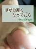 最近増えてます「【トラブルネイル】爪が厚くなってきたら」