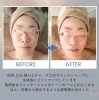 プレミアムフェイシャル、ビフォーアフターアフター「💡キャンペーンのご案内💡」