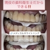被せ物も含めてトータルで口元をキレイに整えました