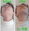 曲がっていた顔が真っ直ぐに！「お顔の左右差やフェイスラインのお悩みに　やさしいリフトアップ体験しませんか？」