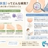 白癬（水虫）ってどんな病気？足を守るために知っておきたいこと