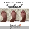 【外反母趾＝痛い人だけの問題ではありません】