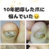 爪が厚くてお悩みではないですか？肥厚爪・巻き爪などの足トラブルに特化したフットケアサロン👣大阪駅・梅田駅から2駅にある完全予約制サロン。個室なのでゆっくりできて安心🏡野田阪神からすぐ🚉