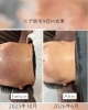 憧れのツル肌へ9回で変身！「ヒゲ脱毛9回の成果【首元ビフォーアフター】」