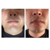 効果実感！看護師が行うメンズヒゲIPL脱毛(Before/After)「メンズひげ脱毛before→after｜青み・肌トーンの変化をご紹介」
