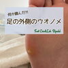 【ウオノメ】何か踏んだ⁈足の外側のウオノメ