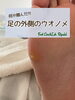 きれいにクリア✨「【ウオノメ】何か踏んだ⁈足の外側のウオノメ」