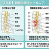なぜ首のヘルニアは治りにくい？整体師が教える「本当の原因」と正しい通い方