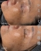 複数回施術で、気になるシミとさよなら「ララピール×IPL光フェイシャルでシミ・くすみケア before→after海南市ララピール」