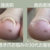 負担の少ない巻き爪ケアとは？