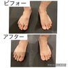 歩くと辛い足小指の痛みが3回で消失！？