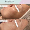 肌再生プラズマ《シミケア》Before→Afterのご紹介