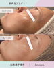 劇的な肌変化！透明感とハリを実感「肌再生プラズマ《シミケア》Before→Afterのご紹介」