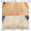 本当に改善されると思っていなかった【福井背中ニキビ/福井ハーブピーリング/福井ニキビケア】