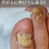爪が前に伸びない❓️爪が厚くなる‼️そんなお悩みないですか❓️足のトラブルに特化したフットケアサロン👣大阪駅・梅田駅から2駅🚃野田阪神すぐ🏡