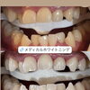 黄ばみが取れると、こんなに白い歯に！メディカルホワイトニング症例