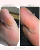 たこケアのBefore・After「足の裏や横にできた厚いタコにお悩みではないですか❓️❓️足のトラブルに特化したフットケアサロン👣大阪駅・梅田駅から2駅にある予約制サロン🏡野田阪神からもすぐなので通いやすい🚶‍➡️」