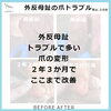 外反母趾で多い爪トラブル・変形爪の2年3か月後　No.108