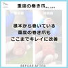 重度の巻き爪もここまで改善　No.109