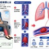 【宮司の健康歳時記７月号】エコノミークラス症候群の予防対策