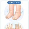 浮腫み（むくみ）でお悩みの方必見！　浮腫みは「水分の摂りすぎ」だけが原因ではありません！
