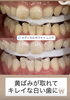 「黄ばみが取れて、透明感のある白い歯に！メディカルホワイトニング症例」