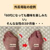 【症例】3か月で外反母趾47°→23°へ｜草津市・60代女性