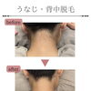 うなじ＋背中脱毛のビフォーアフターと初回料金のご案内