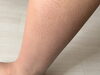 「脱毛すると毛穴のブツブツはどう変わる？腕・脚の自己処理との違い」
