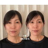 【お悩み:頬骨・面長】ビフォーアフター