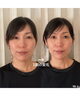 1回の効果に驚き！目もパッチリしました「【お悩み:頬骨・面長】ビフォーアフター」