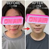 二ヶ月でフェイスラインがスッキリした小顔コースのビフォーアフター