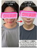 「二ヶ月でフェイスラインがスッキリした小顔コースのビフォーアフター」