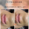 ヒゲ脱毛2回の成果！口元ビフォーアフターをご紹介