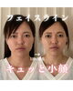 キュッと小顔に！驚きの変化を体験「1度で小顔実感♡7/31までのご来店がお得です」
