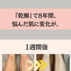 8年間、悩んだ『乾癬』に変化が！