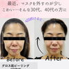 30〜40代の年齢肌サインに♪グロス肌ピーリングがおすすめです！