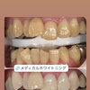 歯の色でここまで変わる！メディカルホワイトニング症例のご紹介