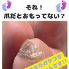 小指の爪の横に何かある‼️小指のトラブルは足トラブルに特化したフットケアサロン👣大阪駅・梅田駅から2駅にある個室サロン🏡野田阪神からすぐ🚃