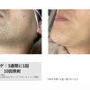 青ヒゲ卒業ですっきり若見え♪ヒゲ脱毛ビフォーアフター【大分市/大在/メンズ脱毛】